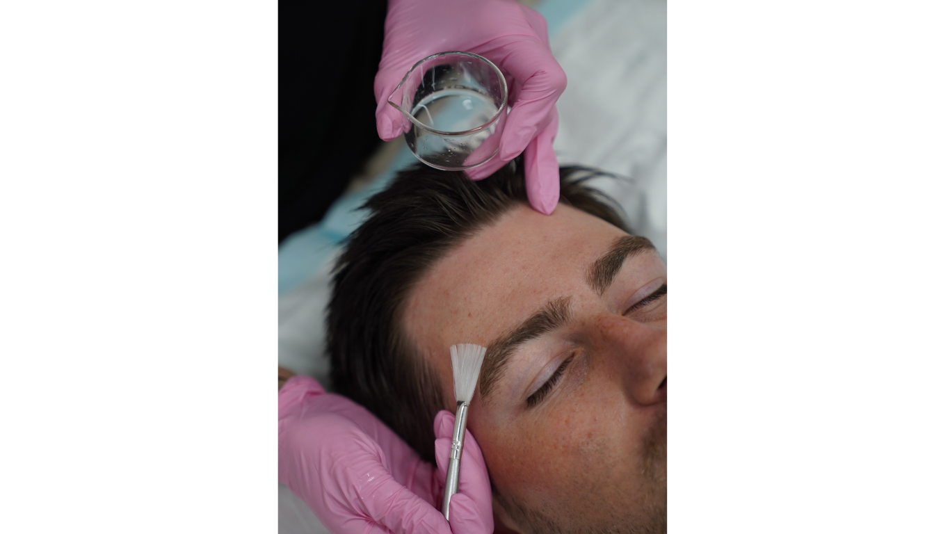 Chemical Peels