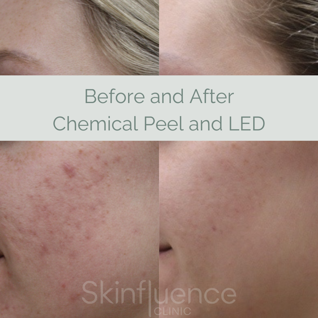 Chemical_Peel_LED.png